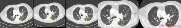 Co<em></em>nfirmed progression in late respo<em></em>nse to therapy (from left): ba<em></em>seline and...