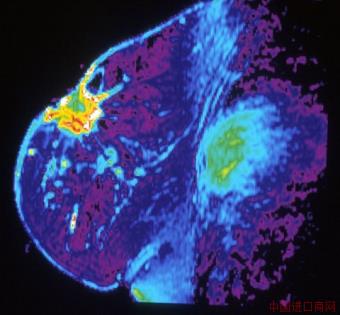 mri of breast