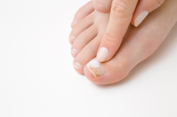 Because nails — especially toenails — grow slowly, treatment tends to be expensive and time-consuming. Here, a woman points to fungus on her big toenail.